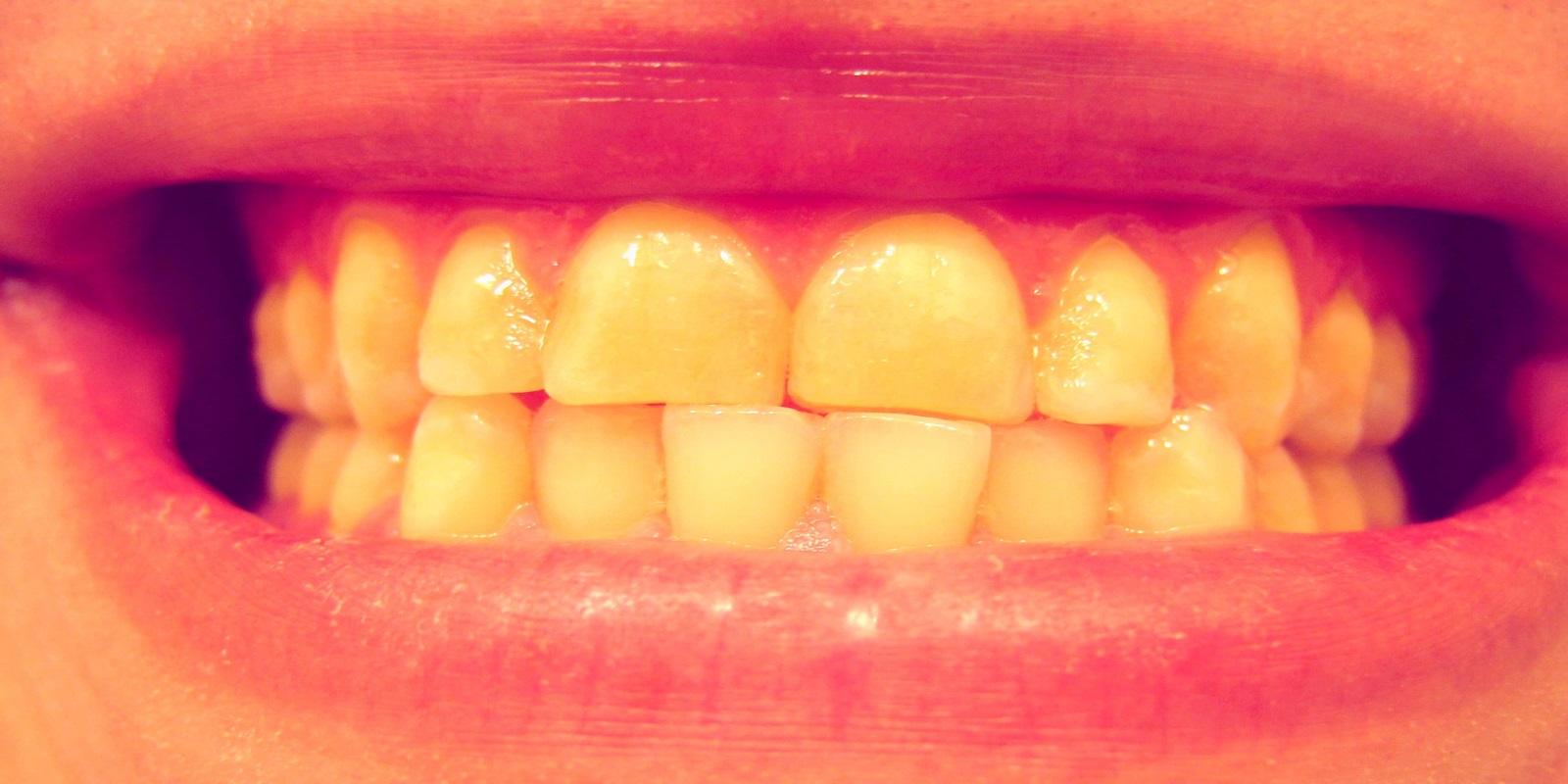 Bruxismo. Ranger de dentes e a Acupuntura